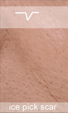 Ice pick or pitted scars are narrow, less than 2mm wide, but deep, forming a V shape in the skin.