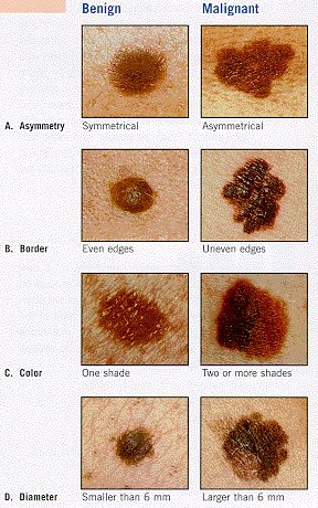 abcd_melanoma - Cosmetic Dermatology Manhattan Beach | Dr Annie Chiu ...
