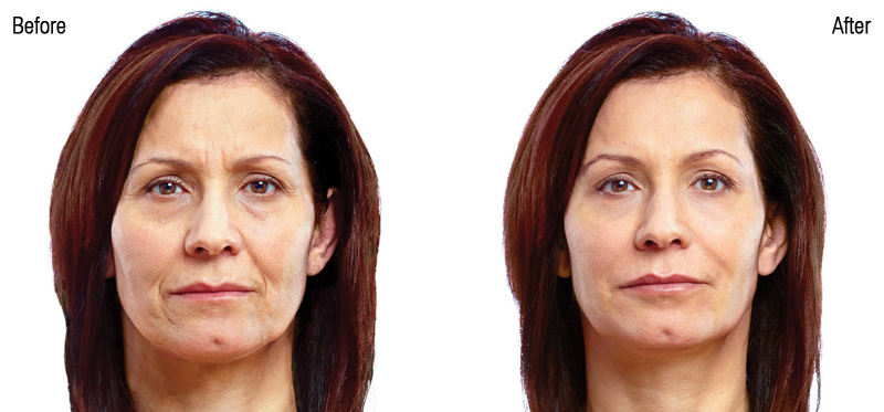 voluma-4-before-after