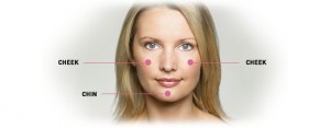 Juvederm Voluma Manhattan Beach