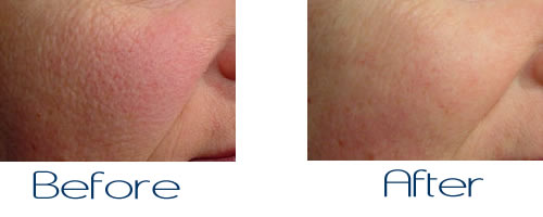 Laser Treatments for Large Pores