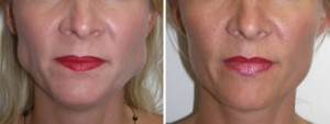 Botox-masseterhypertrophy