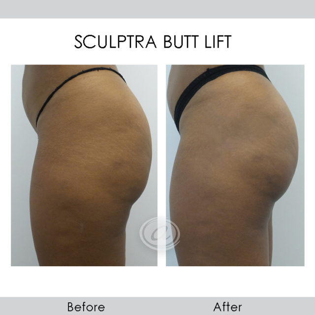 NON-SURGICAL BUTT-LIFT WITH SCULPTRA AND RADIESSE