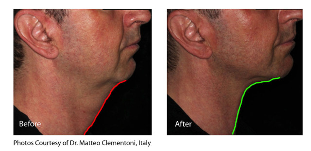 Infini_Clementoni_neckpt1_beforeandafter-01