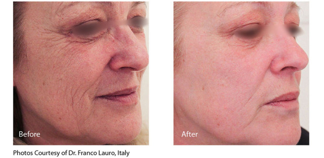 Infini_Lauro_fullface_beforeandafter-2