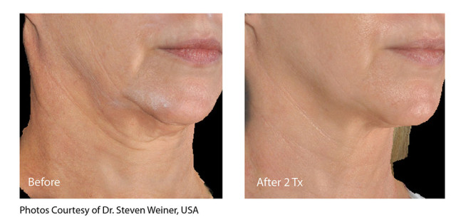 Infini_Weiner_neckpt2_34_beforeandafter-01-0-2