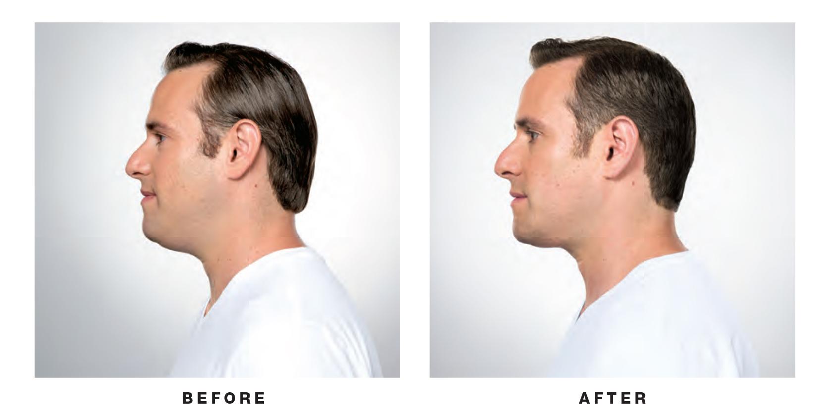 Sculpting the male jawline: Chin and neck contouring 101