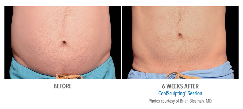 Redondo Beach CoolSculpting Before and After