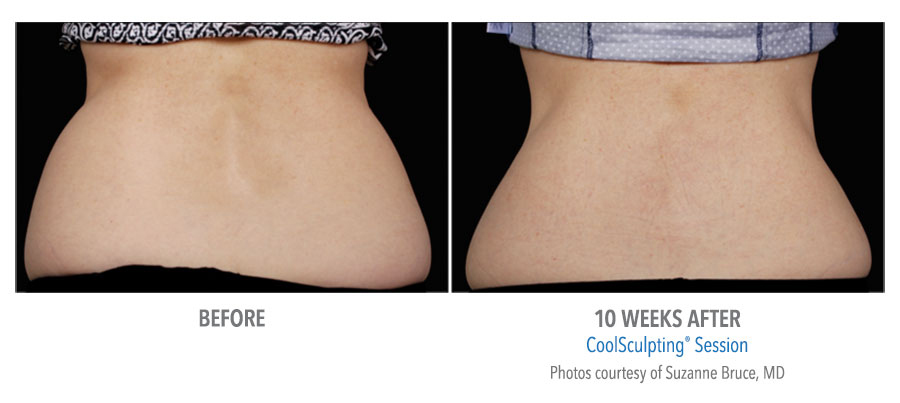 Manhattan Beach CoolSculpting Before and After 