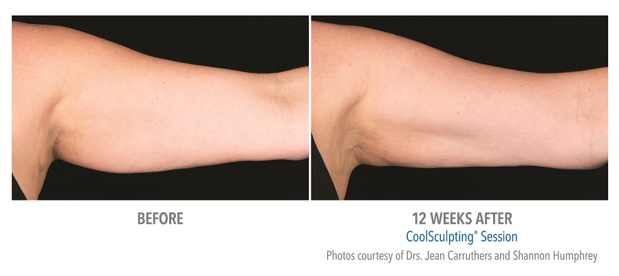 CoolSculpting Arms before and after manhattan beach