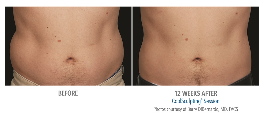 CoolSculpting before and after redondo beach