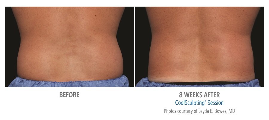 Manhattan Beach CoolSculpting Results