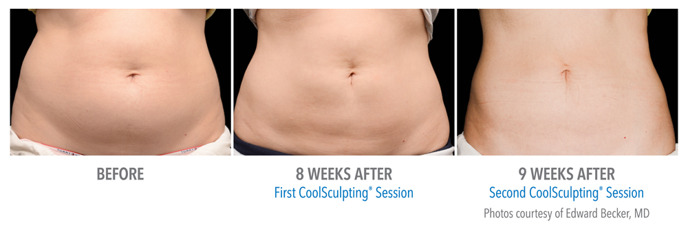 CoolSculpting Manhattan Beach Before and After photos