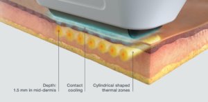 Sofwave Skin Tightening Diagram