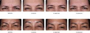 healing process before and after daxxify female patients
