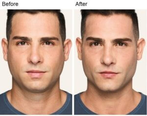 before and after non-surgical chin augmentation and rhinoplasty front view male patient Redondo Beach