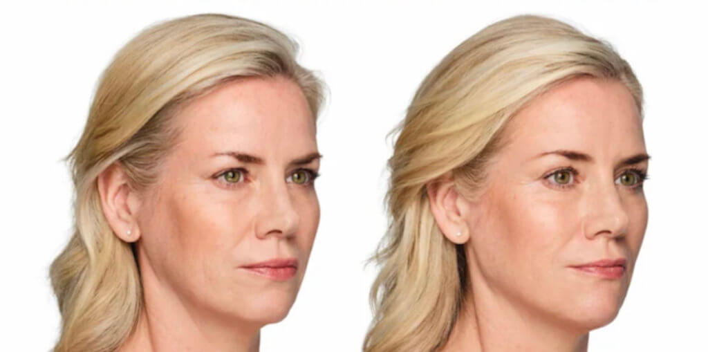 before and after vycross fillers right view female patient The Derm Institute