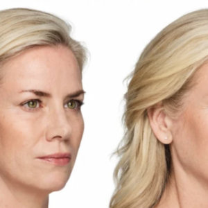 before and after vycross fillers right view female patient The Derm Institute