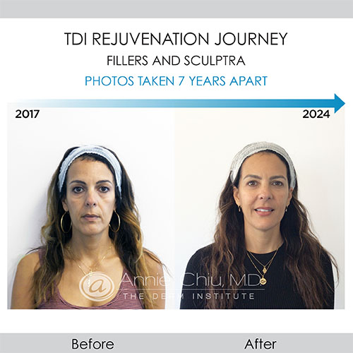 Natural rejuvenation with injectables: botox, fillers, and Sculptra