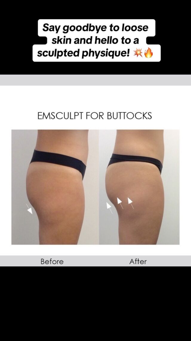 Vanquish | Cosmetic Dermatology Manhattan Beach | Dr. Annie Chiu Redondo  Beach